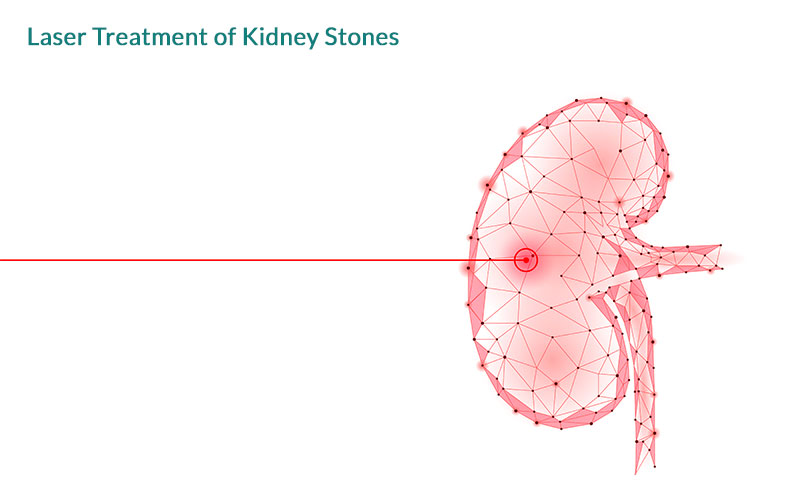 laser-treatment-of-kidney-stones-chennai