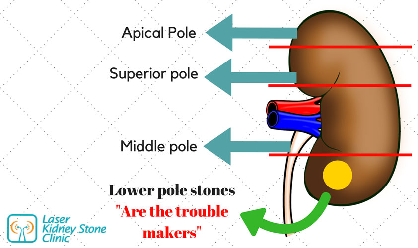 poles-in-kidneys-kidney-stones-clinic-chennai_