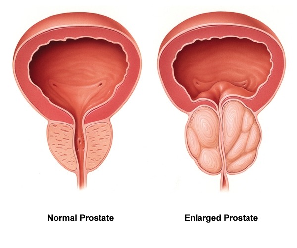 Normal Prostate - Enlarged Prostate