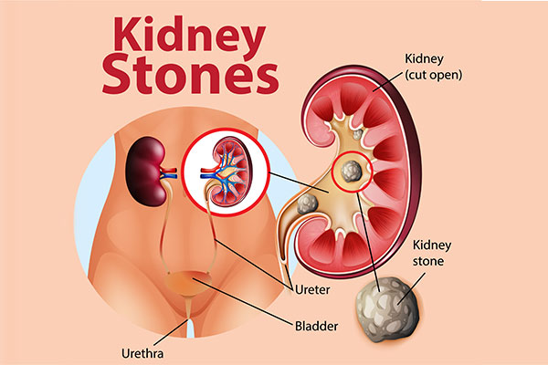 Foods That Cause Kidney Stones